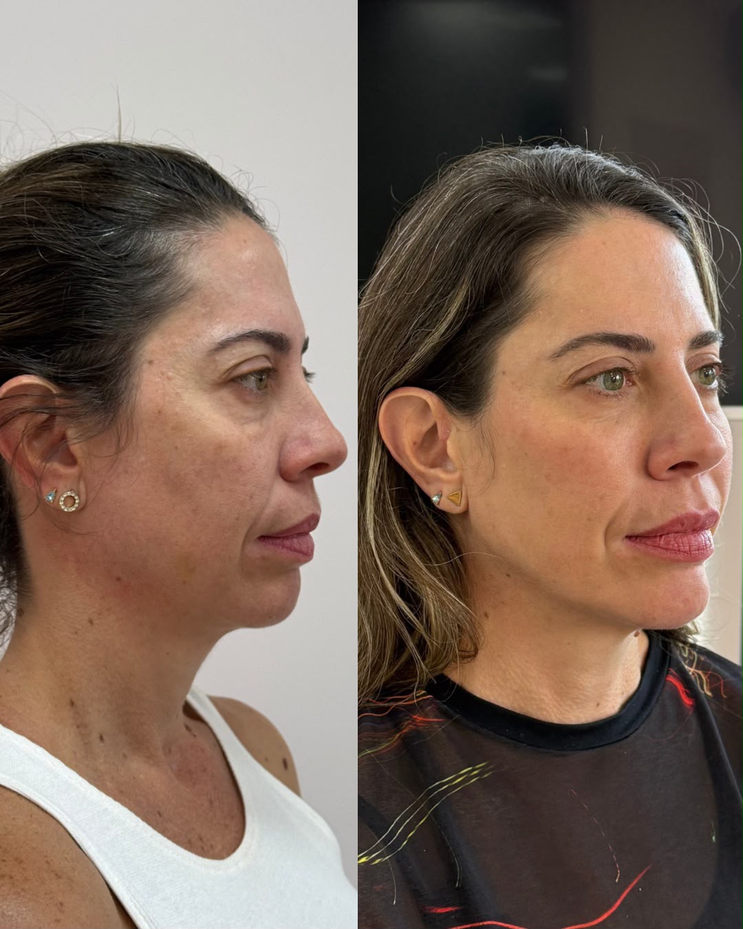 Caso 04 — Perfil e projeção equilibrados: antes e depois
