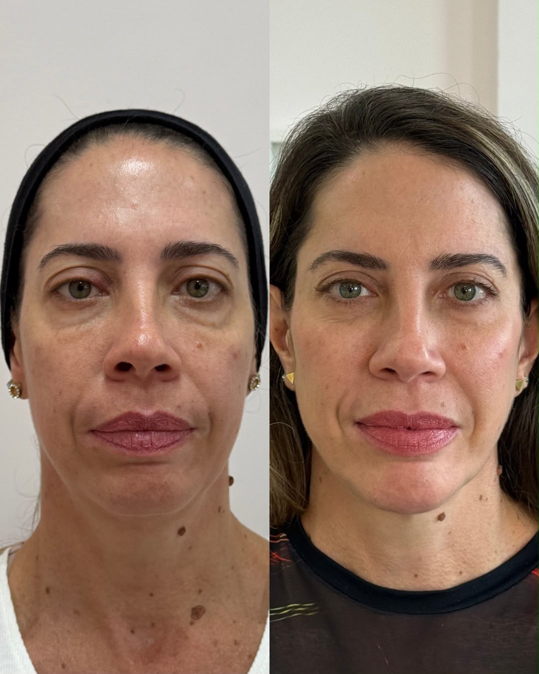 Caso 03 — Sustentação do terço médio: antes e depois